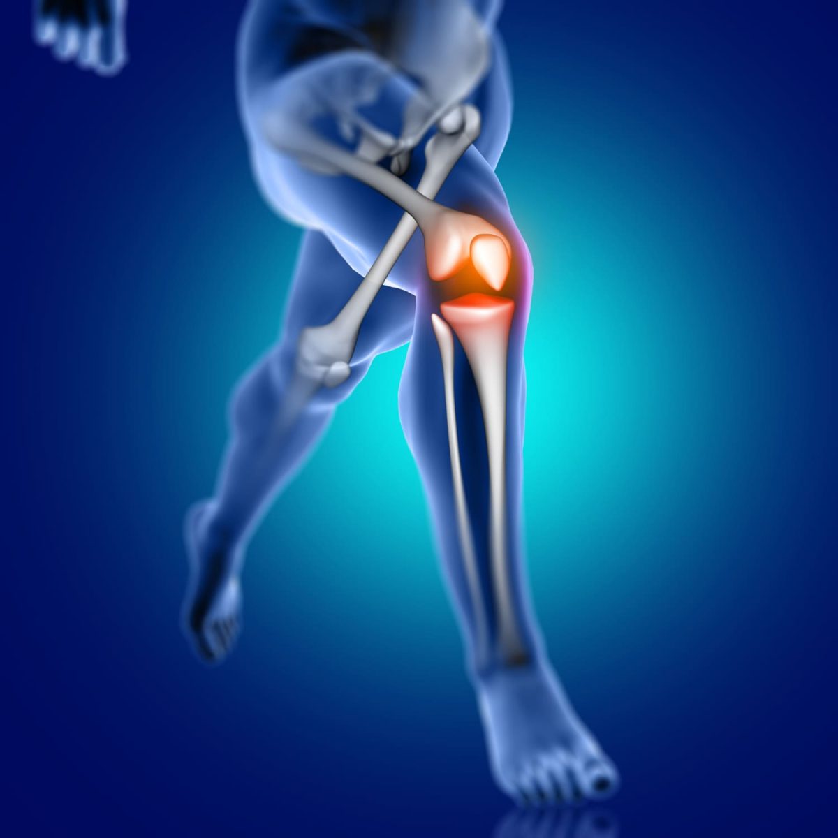 lesion de menisco y lca lesion de menisco y ligamento cruzado anterior fisioterapia menisco y lca