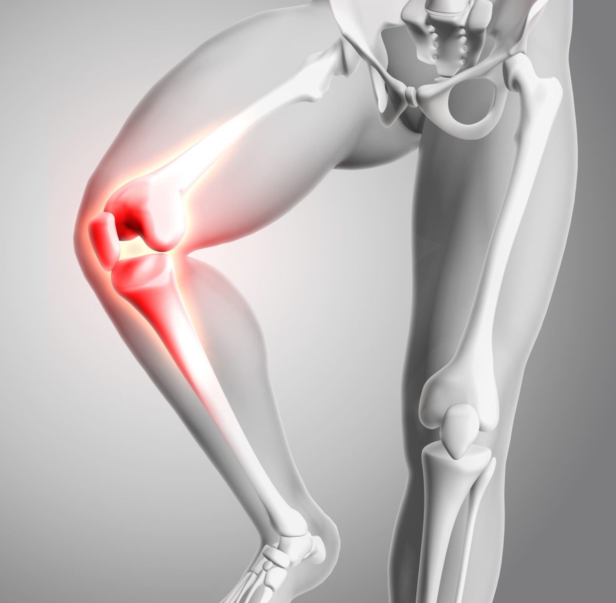 lesion de menisco y lca lesion de menisco y ligamento cruzado anterior fisioterapia menisco y lca