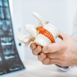 Hernia Discal Lumbar: Diagnóstico Funcional y Rehabilitación Basada en Evidencia