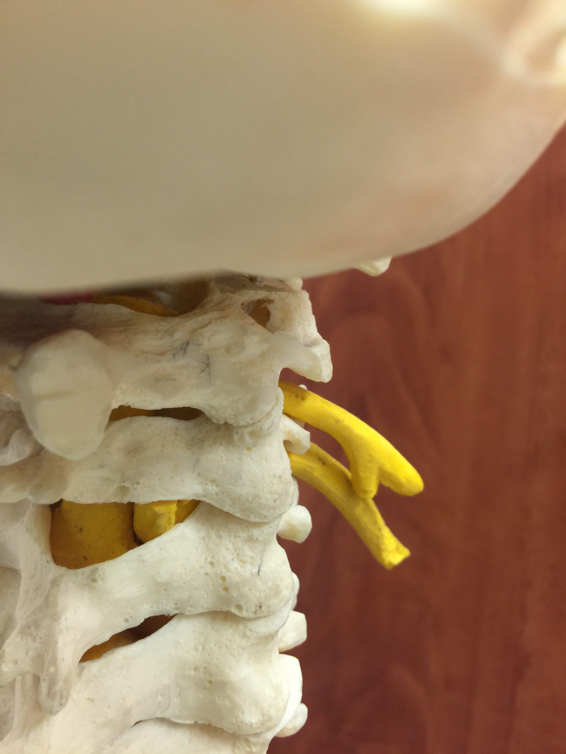 Razonamiento Clínico Avanzado en Radiculopatía Cervical
