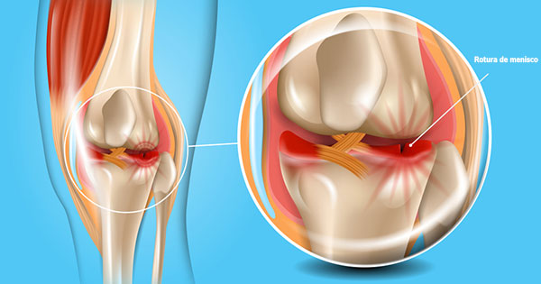 dolor en la parte interna de la rodilla